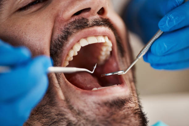 Best Emergency Dentist for Lost Fillings or Crowns in Yulee, FL